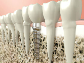 Implants offered in Daytona Beach, FL