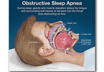 Sleep Apnea, Smiles of Port Orange, Daytona Beach, FL Dentist